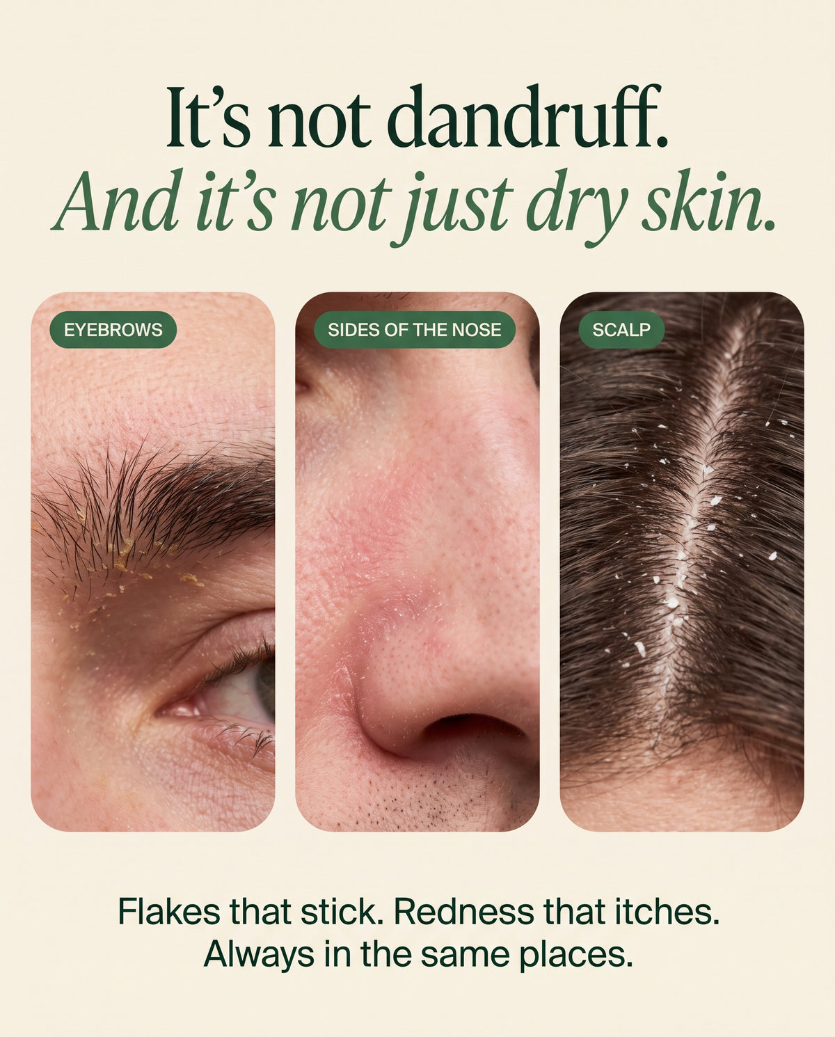 It's not dandruff and it's not just dry skin: eyebrows, sides of the nose, scalp