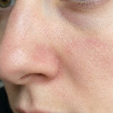 Red, peeling skin by your nose that nothing hides