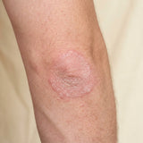 Thick patches no cream gets through