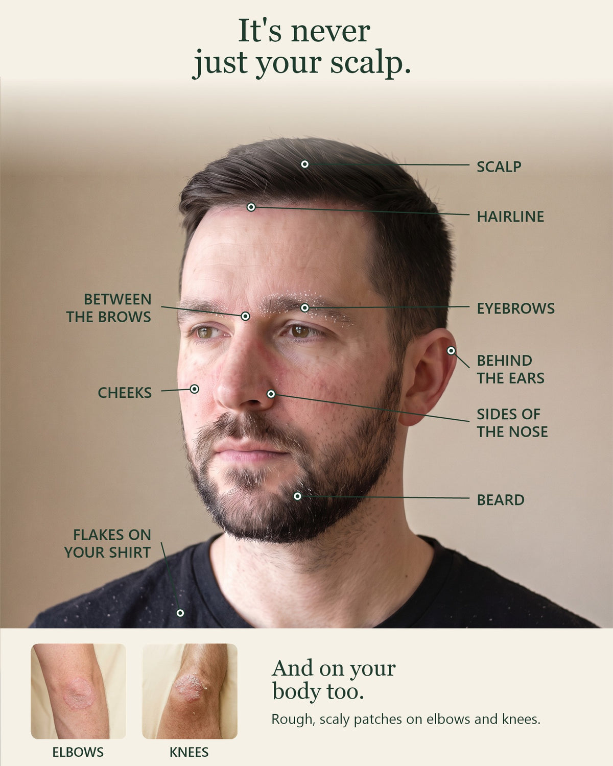 It's never just your scalp: eyebrows, between the brows, sides of the nose, cheeks, hairline, beard, behind the ears, elbows and knees