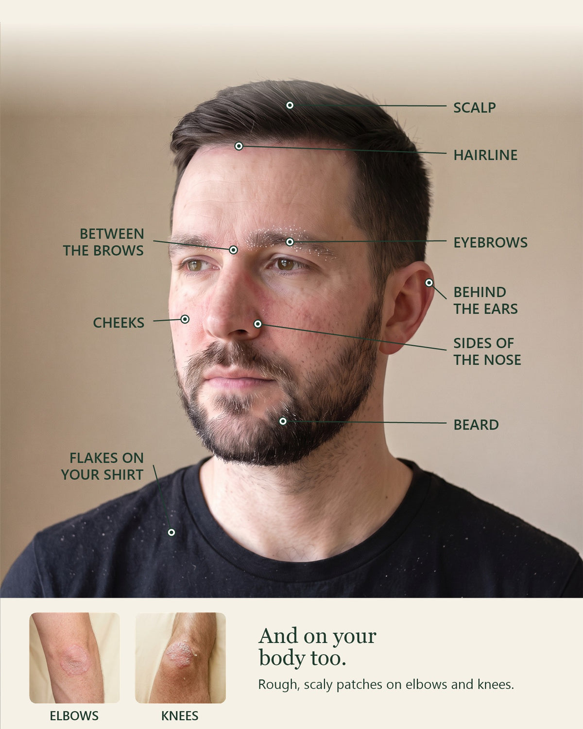 Where flaky, red, itchy skin shows up: scalp, face and body
